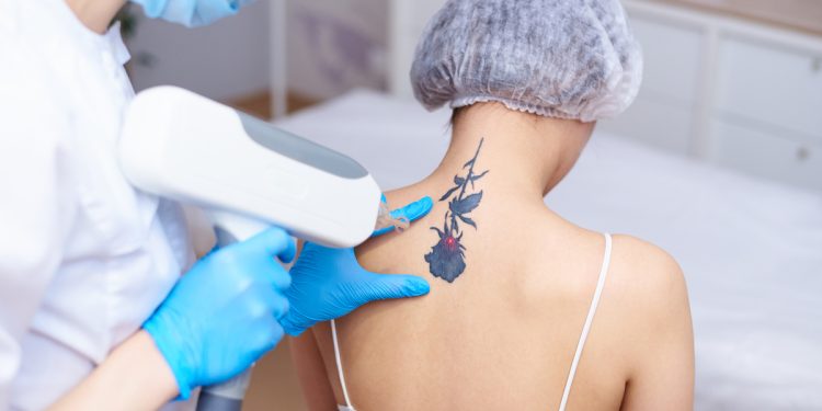 Saúde: Tatuagem não precisa mais ser definitiva