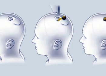 Mundo: EUA autoriza empresa de Musk a testar chip cerebral em humanos