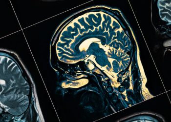 Saúde: Conheça um dos sinais menos reconhecidos como sendo de Alzheimer