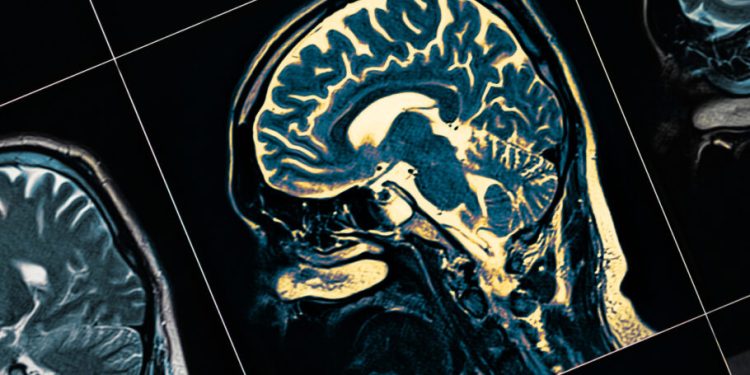 Saúde: Conheça um dos sinais menos reconhecidos como sendo de Alzheimer