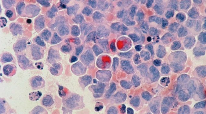 Mundo: Novo tratamento com células-tronco abre caminhos contra a leucemia