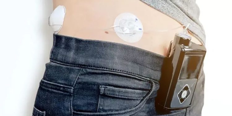 Diabetes: Reino Unido oferece ‘pâncreas artificial’ na rede pública
