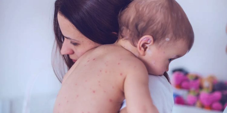 EUA: Aumento de casos ameaça status de erradicação do sarampo no país