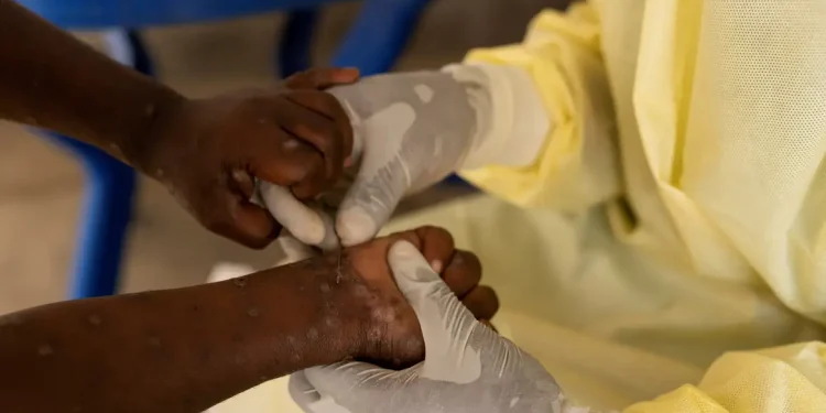 Mpox: Vacina brasileira está próxima dos testes em humanos