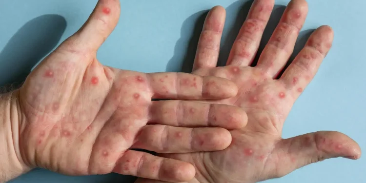 Saúde: Brasil tem média de 40 a 50 novos casos de mpox por mês