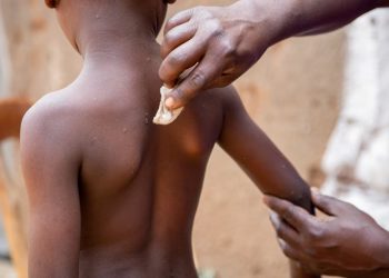 Saúde: UNICEF emite licitação de emergência para garantir vacinas mpox