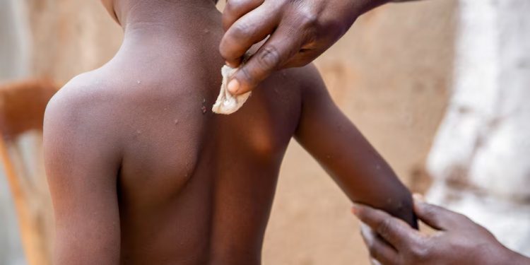 Saúde: UNICEF emite licitação de emergência para garantir vacinas mpox