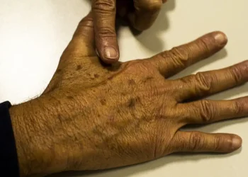 Brasil: Câncer de pele gera R$ 4,6 mi em custos hospitalares em quase 2 anos