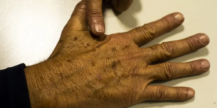 Brasil: Câncer de pele gera R$ 4,6 mi em custos hospitalares em quase 2 anos