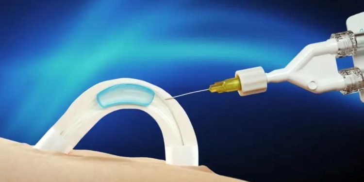 Austrália: Contraceptivo masculino por implante avança em testes