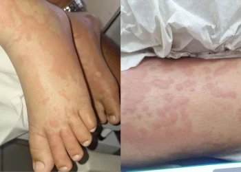 Saúde: Criança é internada por suspeita de contaminação após uso de detergente