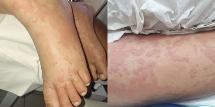 Saúde: Criança é internada por suspeita de contaminação após uso de detergente